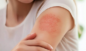 Аллергия на коже (чувствительность кожи)