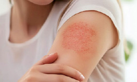 Аллергия на коже (чувствительность кожи) Аллергия на коже (чувствительность кожи)