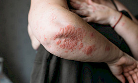 Нейродерматит и проблемы с кожей в зимний период Нейродерматит и проблемы с кожей в зимний период