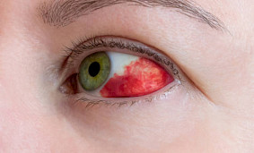 Что такое тромб в глазу и что с этим делать? Что такое тромб в глазу и что с этим делать?