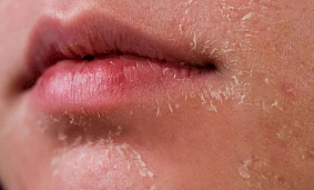 Причины, симптомы и профилактика сухости кожи зимой Причины, симптомы и профилактика сухости кожи зимой