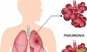 Что такое пневмония и как её лечить? Что такое пневмония и как её лечить?