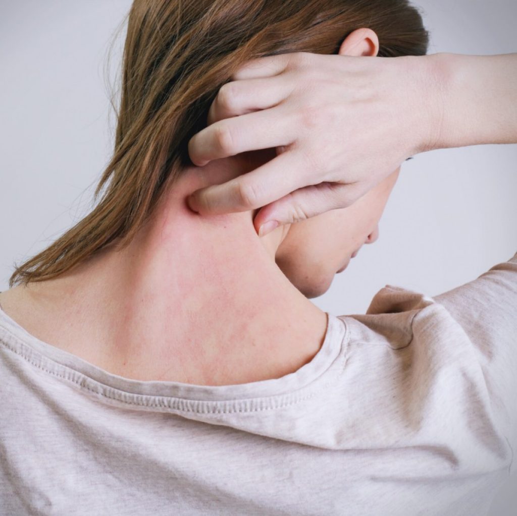 Günəş allergiyası nədir? Əlamətləri, səbəbləri və müalicəsi