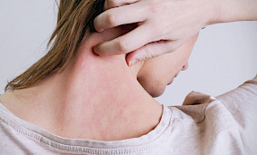 Что такое аллергия на солнце? Симптомы, причины и лечение. Что такое аллергия на солнце? Симптомы, причины и лечение.